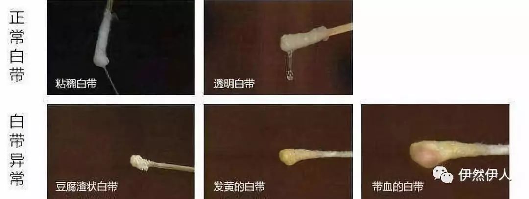 女性阴沟长了个小硬疙瘩女阴沟图，女性私密探索