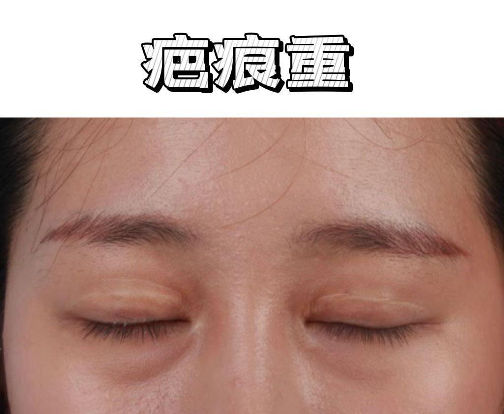竹板打肿臂缝合不上