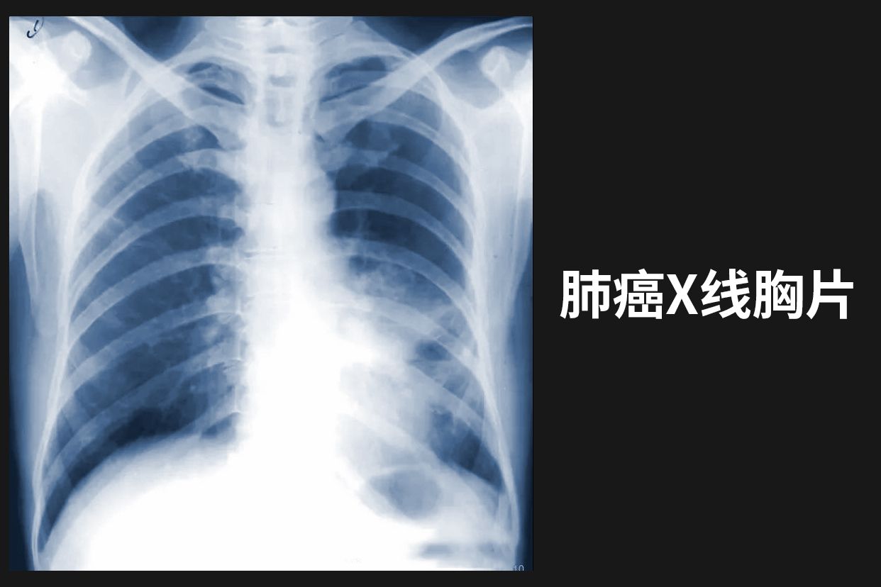 胸片100%曝光胸片100%曝光，影像诊断的精准之选